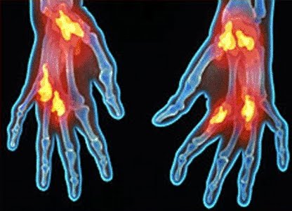 una enfermedad genetica es aquella producida por una enfermedad genetica es aquella producida por